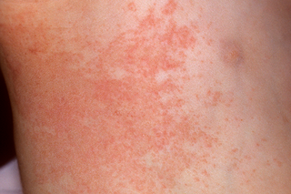 A red, patchy rash with some small, raised bumps, on the side of a child's chest. Shown on white skin