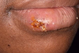 Burst cold sore that has become a scab on the lower lip of someone with dark brown skin.