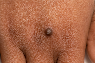 A dark brown, circular wart on the back of a person's hand. Shown on brown skin.