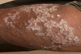 Patches of psoriasis on someone's arm. The image shows a raised, dark brown rash with white scales on brown skin.