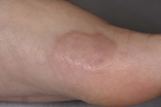 The inside of a child’s foot with a lump underneath the skin. The image is on white skin and the lump is skin-coloured.