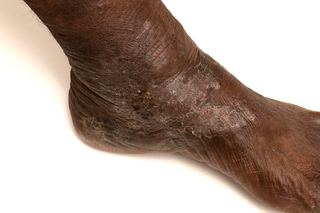 Varicose eczema on dark brown skin. A silvery-grey and purple scaly rash covering part of the lower leg.