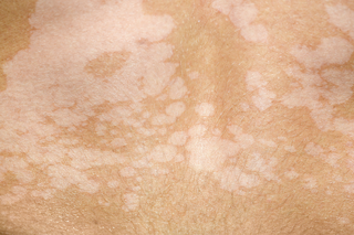A close-up of pityriasis versicolor on brown skin. There are several flat, pale patches covering the skin and some have joined together to form large pale areas.
