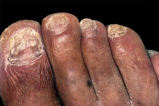 A person's toenails that are thickened and discoloured. The person has medium brown skin and their toenails are covered in white patches.