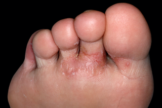 Pompholyx on the foot of someone with white skin. The skin underneath the toes looks red, cracked and sore.