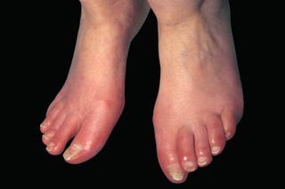 Red, blotchy toes caused by erythromelalgia. Shown on white skin.