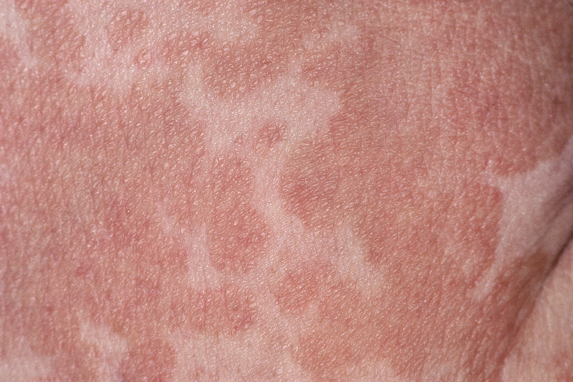 Pityriasis Versicolor Nhs 