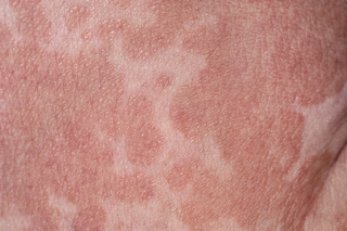 A close-up of pityriasis versicolor on white skin. The skin is covered in pink, blotchy patches that have joined together to form large pink areas.