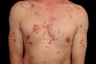 Pemphigus vulgaris in someone with white skin. There are lots of small red patches covering the chest, tummy, shoulders and arms.