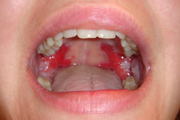 canker sore on soft palate