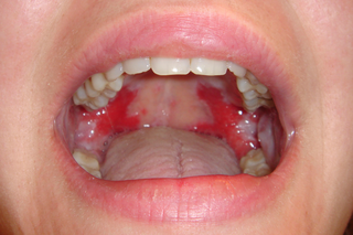 Pemphigus vulgaris inside a person’s mouth. There are red, sore-looking patches covering the roof of the mouth.