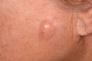 A round lump on a person’s left cheek. The person has white skin and the lump is the same colour as their skin.