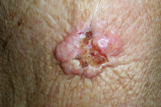 A raised pink growth with a light brown area in the middle that looks like a scab. Shown on white skin.