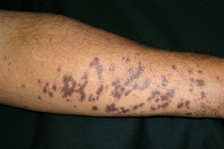 Lichen planus on the inside of the arm of a person with black skin.