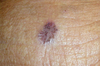 A flat purple mark with uneven edges on a person's forehead. Shown on light brown skin.