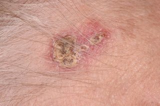 A dry, crusty patch on white skin. The patch is yellow and brown, has an irregular border and looks like a scab.