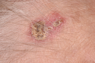 A dry, crusty patch on white skin. The patch is yellow and brown, has an irregular border and looks like a scab.