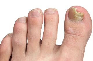 The toes on the left foot of a person with white skin. The right side of their big toenail is yellow and there's a piece missing from the tip of the nail.