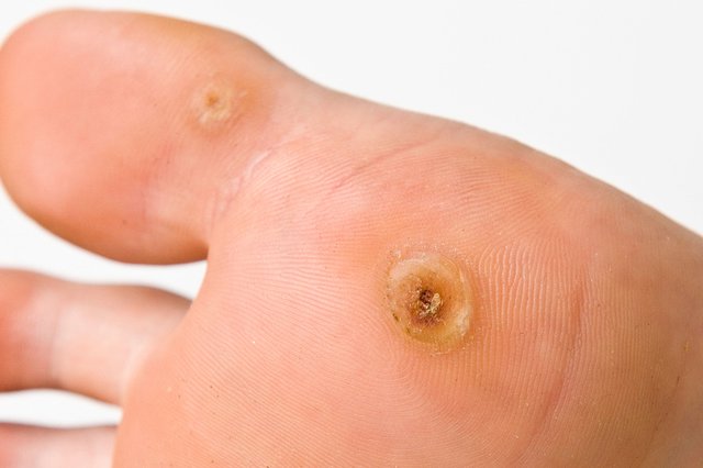 warts on hands nhs
