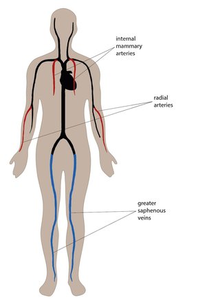 Illustrated diagram showing the location of internal mammary arteries in the chest, radial arteries in the forearms and greater saphenous veins in the legs