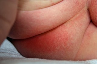 Rash on a baby's bottom. There is 1 very red patch. The skin surrounding that area is pink. Shown on white skin.