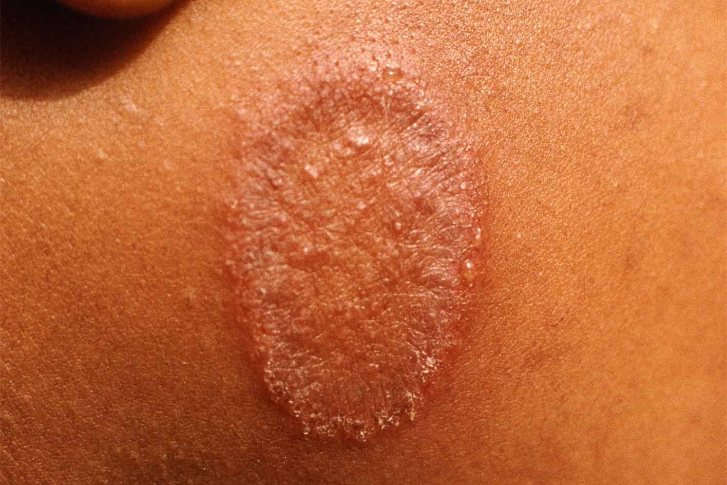 Ringworm NHS Ringworm NHS