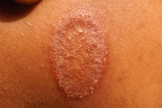 An oval-shaped patch of scaly, reddish-brown skin on a child's cheek, caused by ringworm. Shown on medium brown skin.