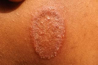 An oval-shaped patch of scaly, reddish-brown skin on a child's cheek, caused by ringworm. Shown on medium brown skin.