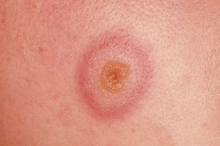Erythema multiforme on white skin. Close-up of a yellow and red raised spot with a pink-red ring around it.