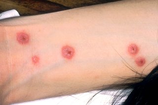 Stevens-Johnson syndrome rash on the arm of a person with white skin. There are 5 red, circular patches, each with a darker area of skin in the centre.