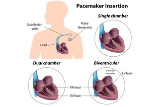 Diagram showing the 3 main types of pacemaker, single-chamber, dual-chamber and biventricular.