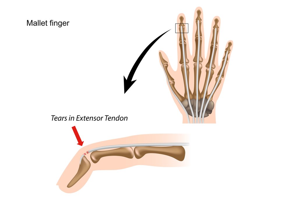 Mallet finger NHS NHS