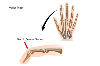 Diagram of mallet finger