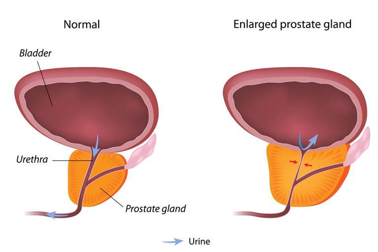 benign-prostate-enlargement-nhs