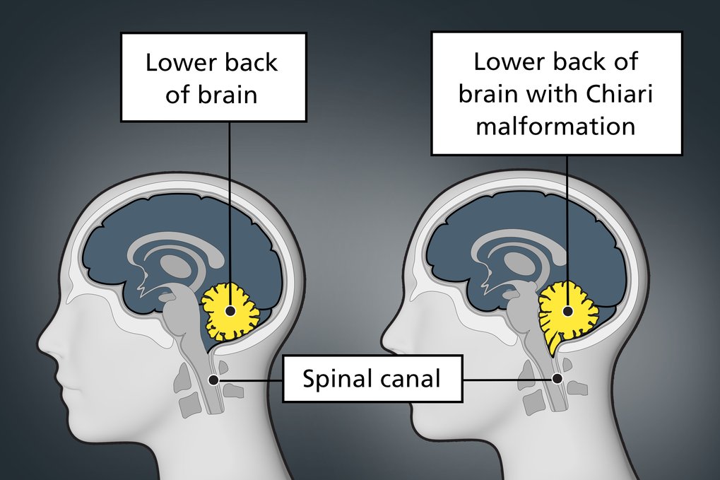 chiari-malformation-nhs