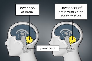 An illustration showing 2 brains. One is normal. The other has Chiari malformation and shows the lower brain pushing forward and down into the spinal canal.