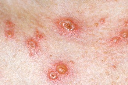 Stage 3 of chickenpox on white skin. A detailed description of this image is available next.
