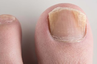 The nail on a person's big toe. The sides of the nail are yellow and the edge that's trimmed is flaky. Shown on white skin.