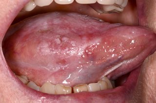 Close up of cancer on the tongue. There are pale, slightly raised patches and redness on the side and top of the tongue.