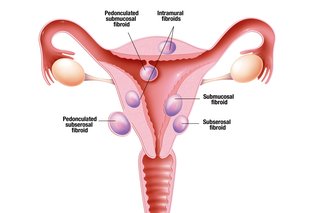 Diagram of the womb showing where the different types of fibroids develop.