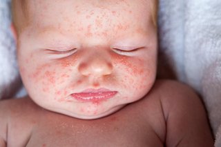 A red, spotty rash all over a baby's face. Some spots are in clusters. Shown on white skin.