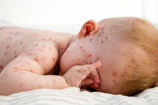 A red, spotty rash on the face, arms and back of a child caused by chickenpox. Shown on white skin.