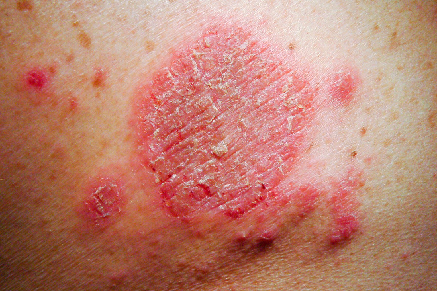 Discoid Eczema NHS