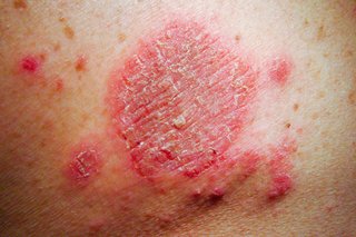 A large patch of red flaky skin surrounded by several smaller red patches and bumps
