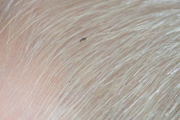 Head lice and nits - NHS