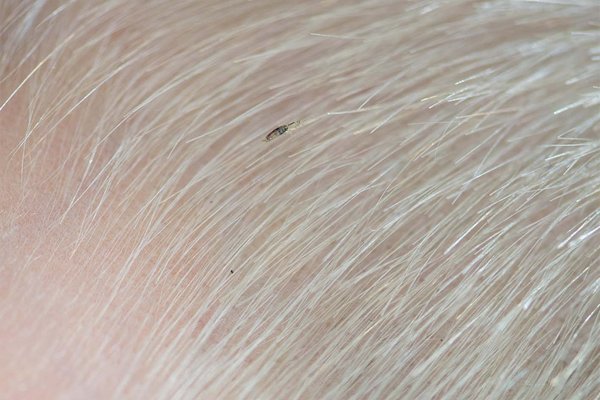 Human lice on hair hotsell