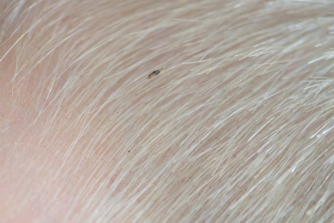 Head lice and nits - NHS