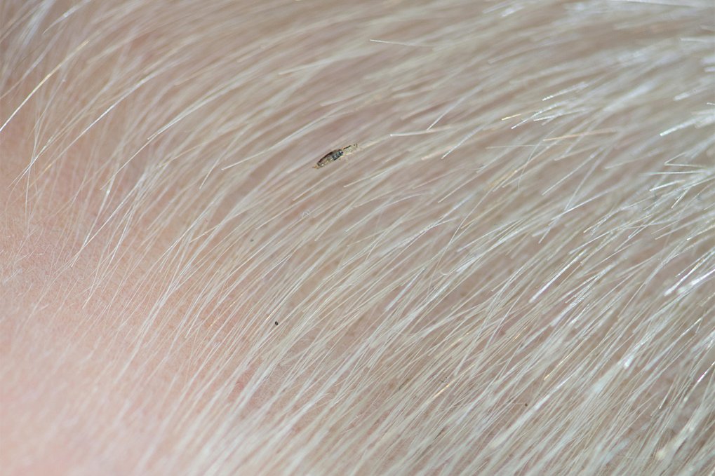 Head lice and nits NHS