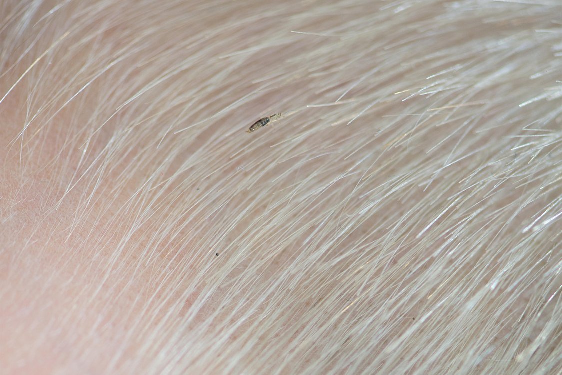 Head lice and nits NHS