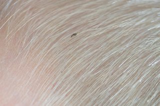 A head louse in hair on the scalp.